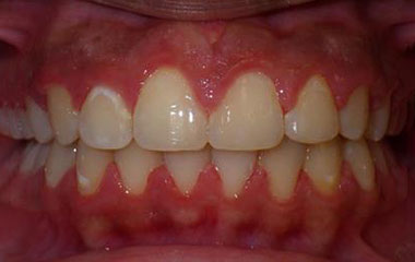 Benjamin - After Braces Results | Prairie View Orthodontics