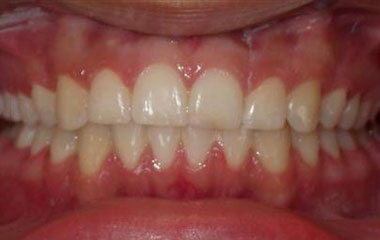 Raziel - After Braces Results | Prairie View Orthodontics