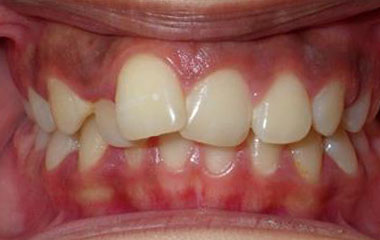 Benjamin - Before Braces Results | Prairie View Orthodontics
