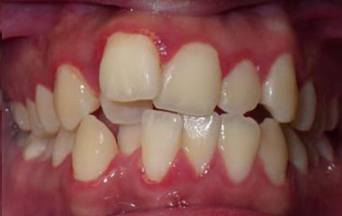 Fernando - Before Braces Results | Prairie View Orthodontics