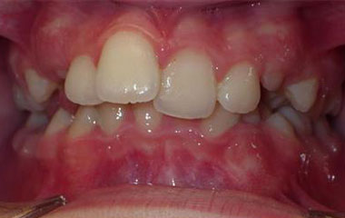 Giada - Before Braces Results | Prairie View Orthodontics