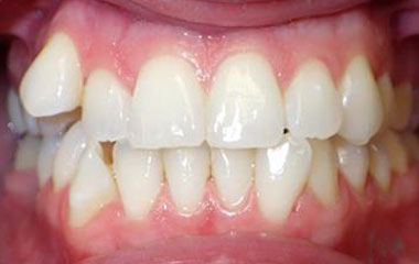 Alexandria - Before Invisalign Results | Prairie View Orthodontics