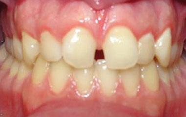 Joshua - Before Invisalign Results | Prairie View Orthodontics