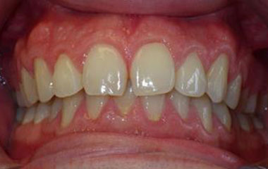 Lizeth - Before Braces Results | Prairie View Orthodontics